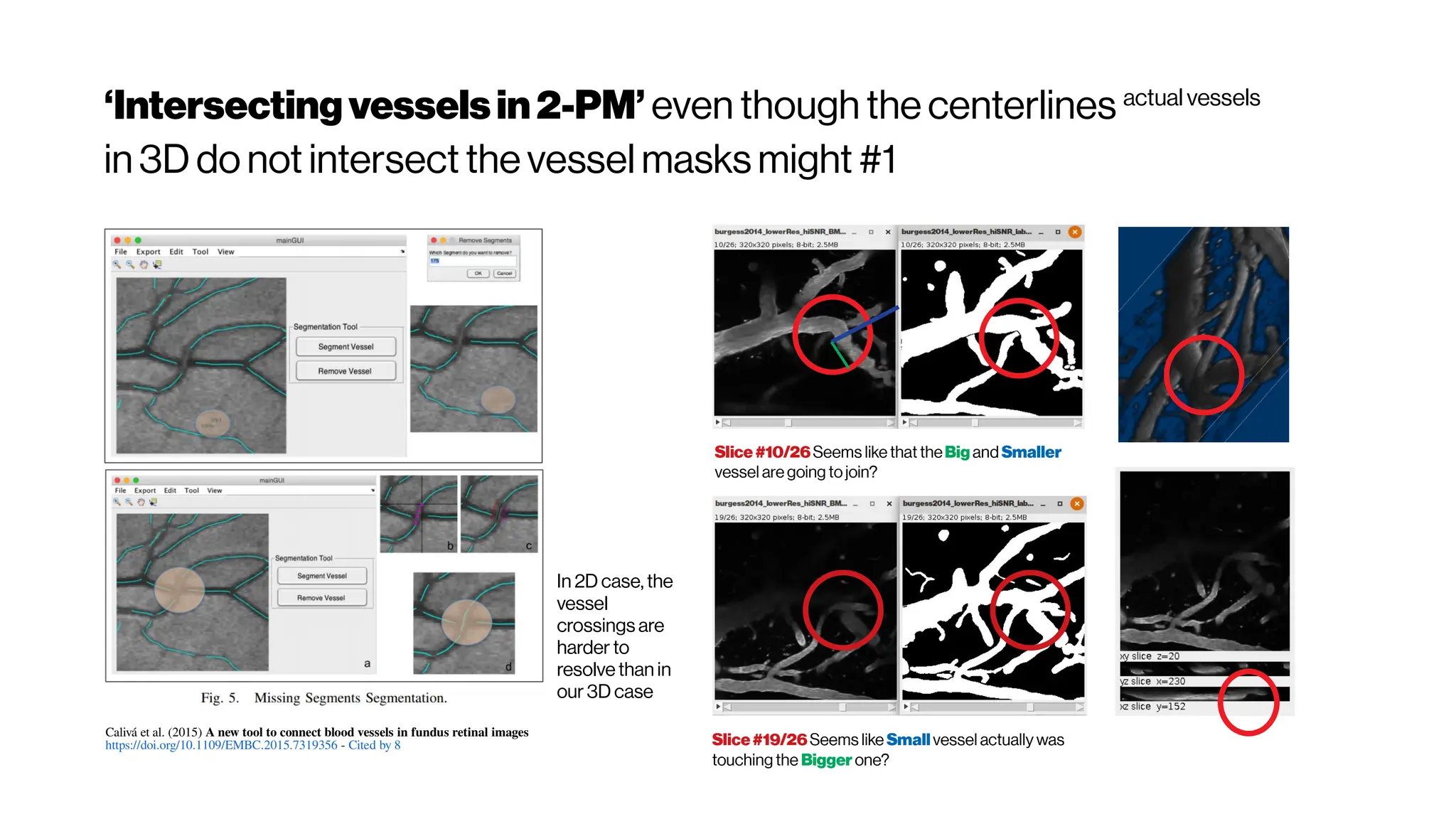 ‘Intersectingvesselsin2-PM’ even though the centerlines actual vessels
in 3D do not intersect the vessel masks might #1
Calivá et al. (2015) A new tool to connect blood vessels in fundus retinal images
https://doi.org/10.1109/EMBC.2015.7319356 - Cited by 8
In 2D case, the
vessel
crossings are
harder to
resolve than in
our 3D case
Slice#10/26Seems like that theBig and Smaller
vessel are going tojoin?
Slice#19/26Seems like Smallvessel actually was
touching the Biggerone?
 