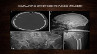 SKELETAL SURVEY: LYTIC BONE LESIONS (PUNCHED OUT LESIONS)
 