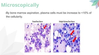 Myeloma is a malignant disease of the plasma cells of bone marrow ...