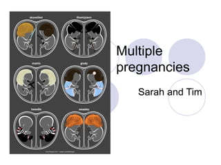 Multiple
pregnancies
Sarah and Tim
 