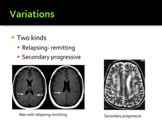 Two kinds Relapsing- remitting  Secondary progressive  Man with relapsing-remitting  Secondary progressive 