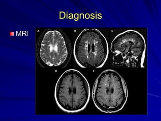 Diagnosis
MRI
 