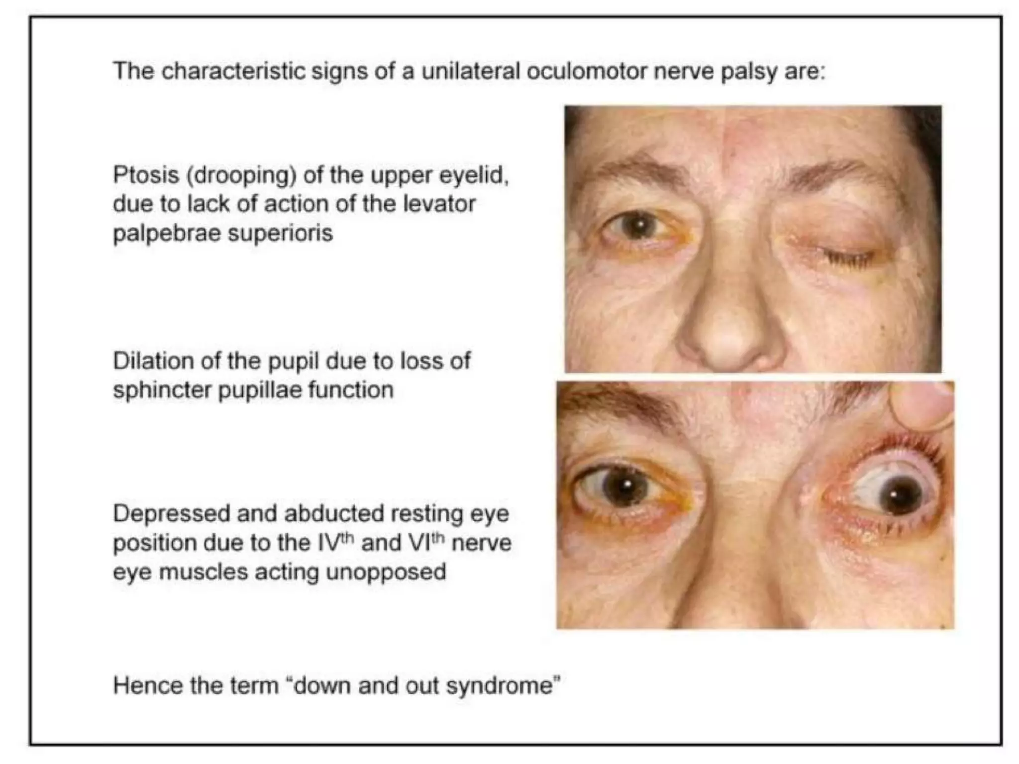 Multiple cranial nerve palsy final | PPTX