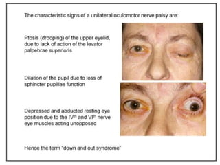 Multiple cranial nerve palsy final | PPTX