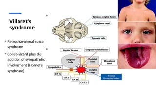 Multiple Cranial Nerve Pabbbbblsy Med.pptx