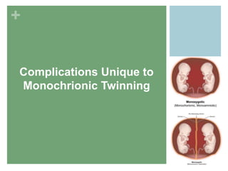 +
Complications Unique to
Monochrionic Twinning
 
