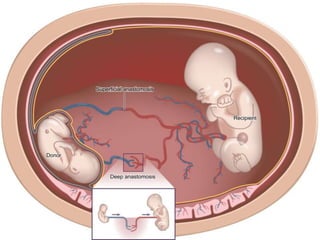 +
 Twin-to-twin transfusion syndrome (15%)
 Growth-restricted fetus (donor)  Hypovolaemic and oligouric
 oligohydramnios
 Recepient  hypervolaemic  polyuria polyhydramnios
 