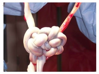 +
 Increased cord accidents, mainly through their universal cord
entanglement.
 This could be acute, fatal and unpredictable.
 Many clinicians support elective CS at 32-34 weeks.
 