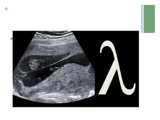 +
 In dichorionic twins there is a V shape extension of placental
tissue into the base of the intertwin membrane (Lambda or twin
peak sign).
 