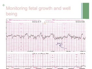 +
Monitoring fetal growth and well
being
 Measuring symphysis fundal height
 Presence of fetal movements
 Doppler investigations
 CTG
 