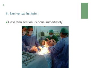 +
 Cesarean section is done immediately
III. Non vertex first twin:
 