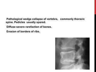 Pathological wedge collapse of vertebra, commonly thoracic
spine. Pedicles usually spared.
Diffuse severe rarefaction of bones.
Erosion of borders of ribs.
 