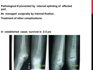 Pathological # prevented by internal splinting of affected
part.
#s managed surgically by internal fixation .
Treatment of other complications.
In established cases survival is 2-3 yrs
 