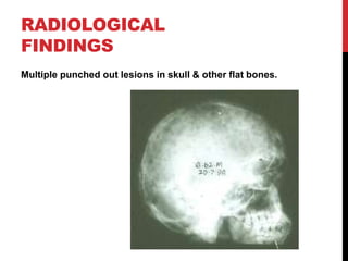 RADIOLOGICAL
FINDINGS
Multiple punched out lesions in skull & other flat bones.
 