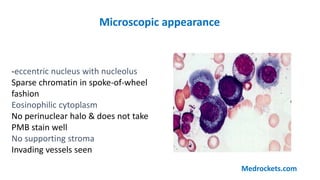 -eccentric nucleus with nucleolus
Sparse chromatin in spoke-of-wheel
fashion
Eosinophilic cytoplasm
No perinuclear halo & does not take
PMB stain well
No supporting stroma
Invading vessels seen
Microscopic appearance
Medrockets.com
 