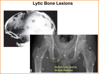 Lytic Bone Lesions
 