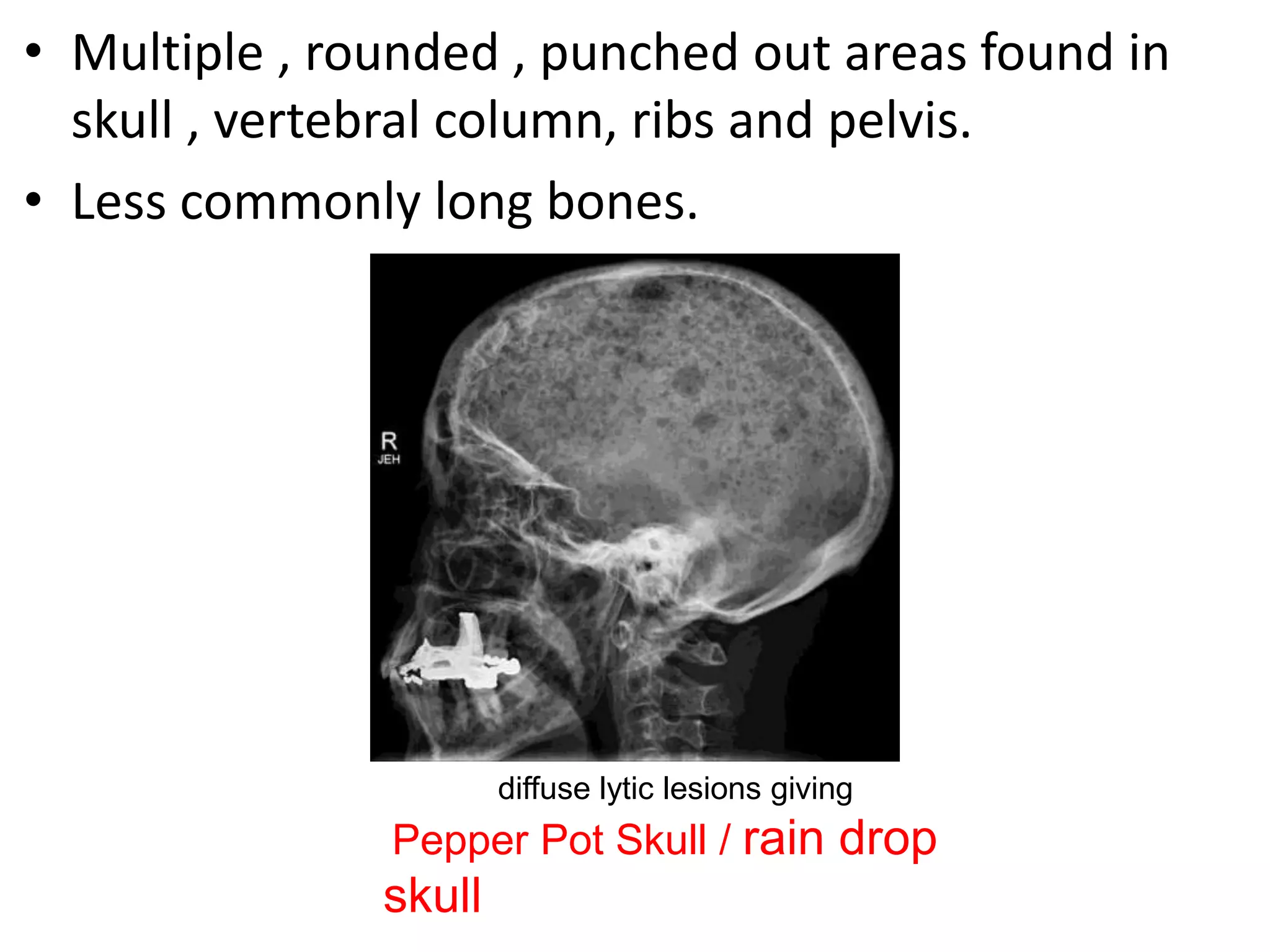 • Multiple , rounded , punched out areas found in
skull , vertebral column, ribs and pelvis.
• Less commonly long bones.
diffuse lytic lesions giving
Pepper Pot Skull / rain drop
skull
 