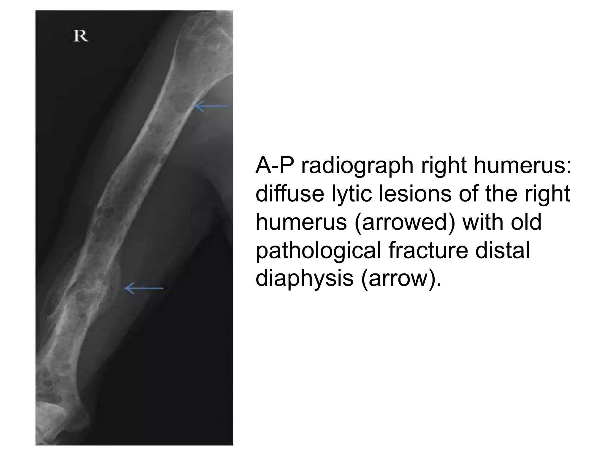 A-P radiograph right humerus:
diffuse lytic lesions of the right
humerus (arrowed) with old
pathological fracture distal
diaphysis (arrow).
 