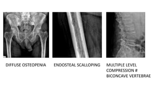 DIFFUSE OSTEOPENIA ENDOSTEAL SCALLOPING MULTIPLE LEVEL
COMPRESSION #
BICONCAVE VERTEBRAE
 