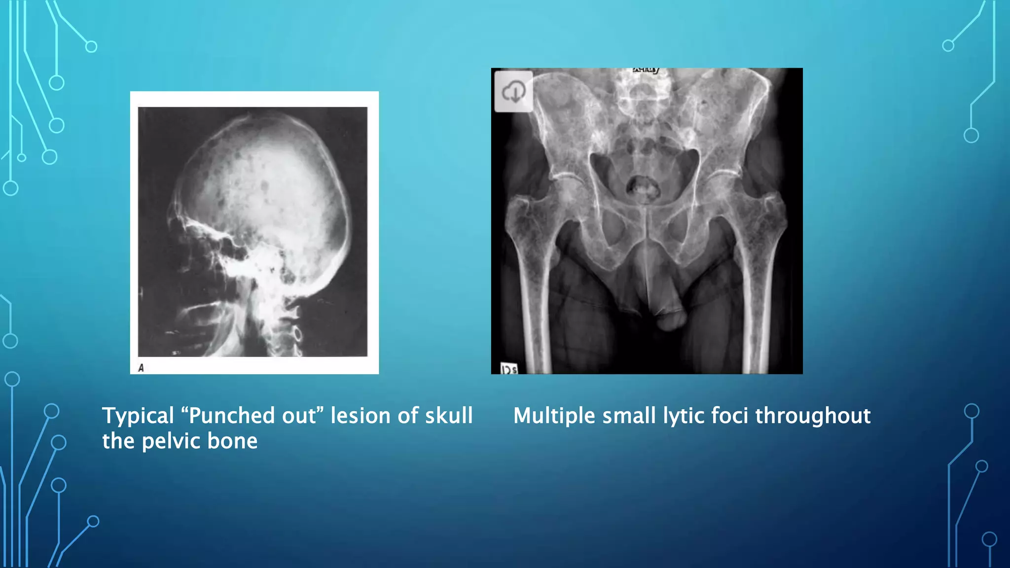 Typical “Punched out” lesion of skull Multiple small lytic foci throughout
the pelvic bone
 