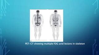 PET-CT showing multiple FDG avid lesions in skeleton
 