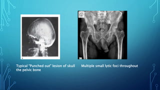 Typical “Punched out” lesion of skull Multiple small lytic foci throughout
the pelvic bone
 