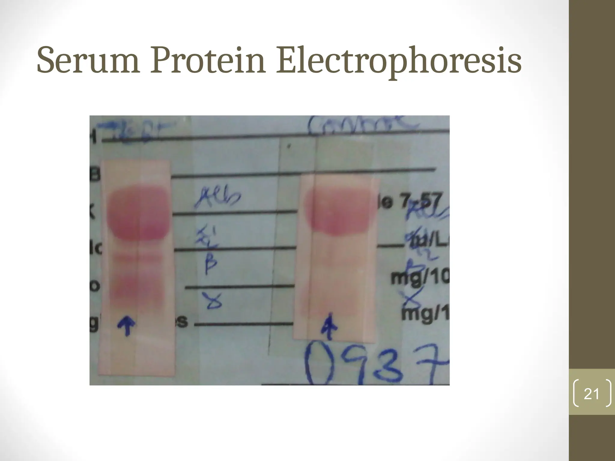 Serum Protein Electrophoresis
21
 