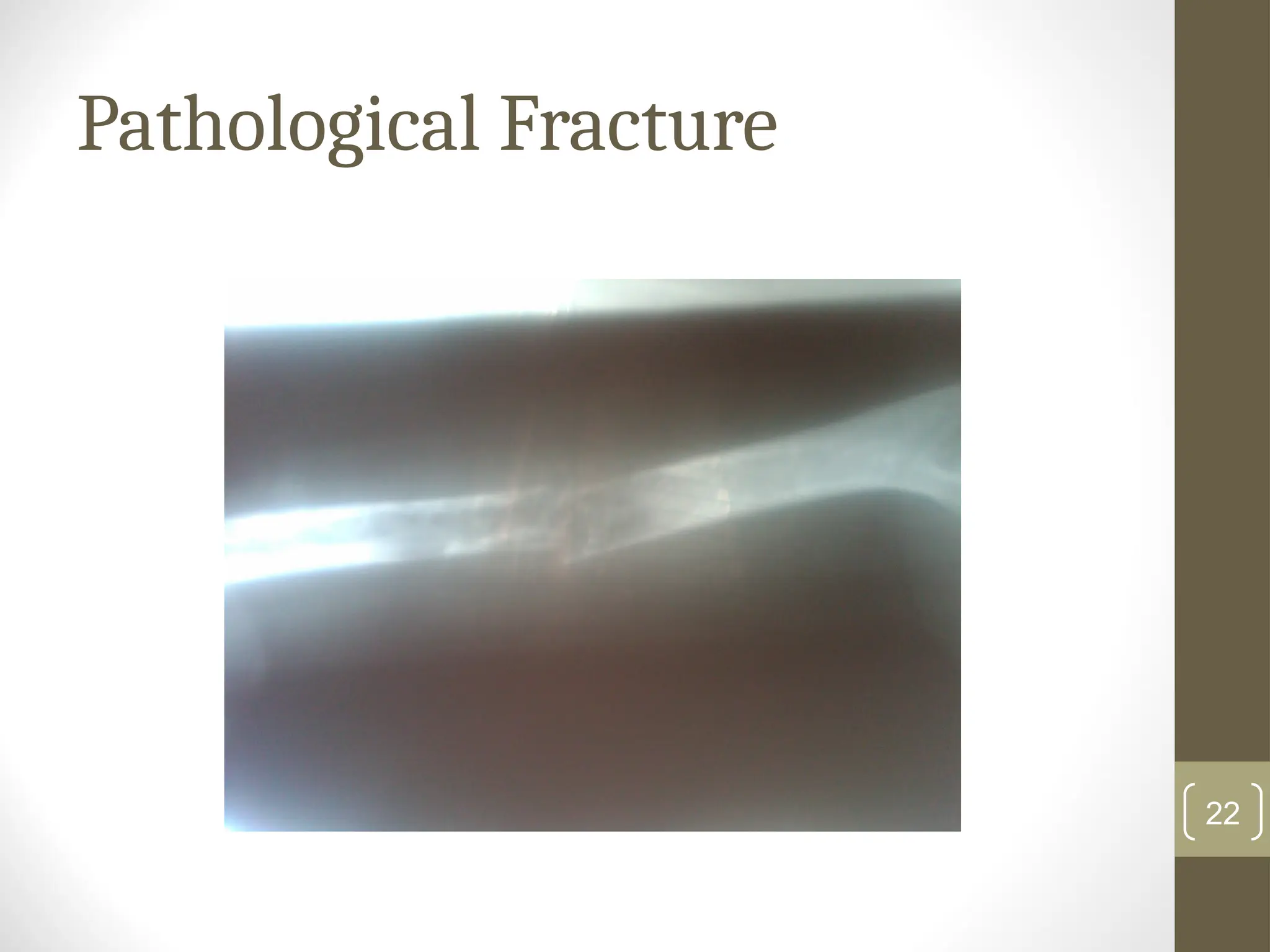 Pathological Fracture
22
 