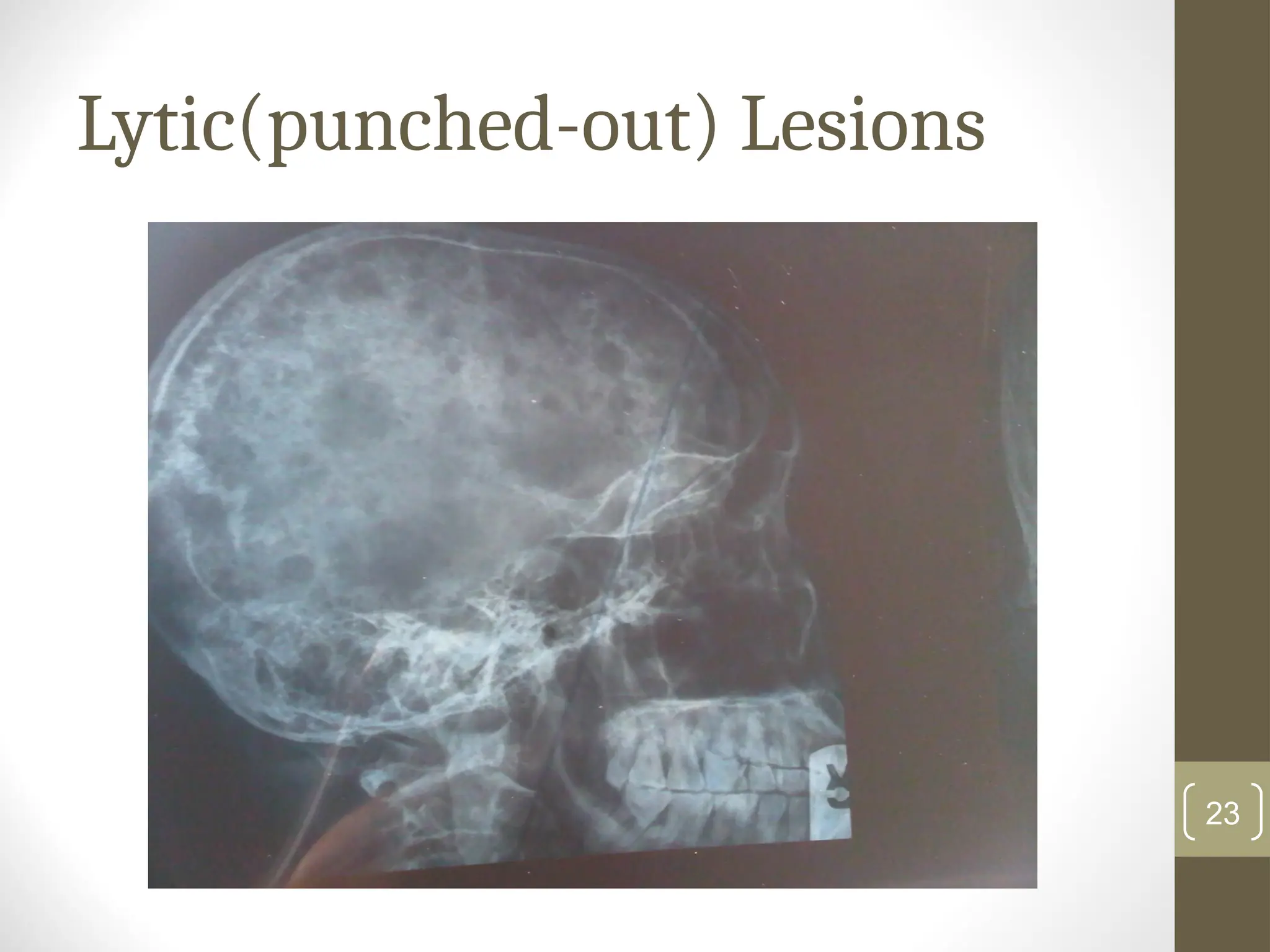 Lytic(punched-out) Lesions
23
 