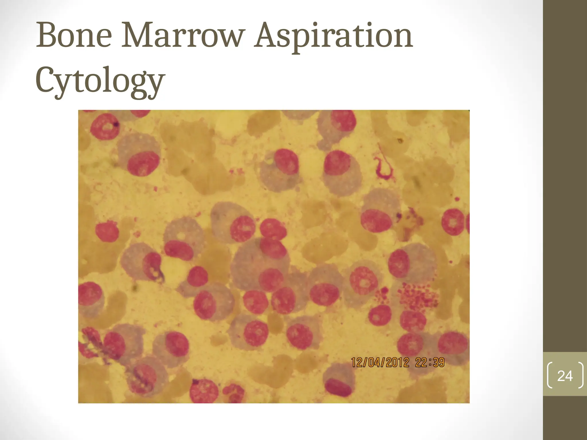 Bone Marrow Aspiration
Cytology
24
 