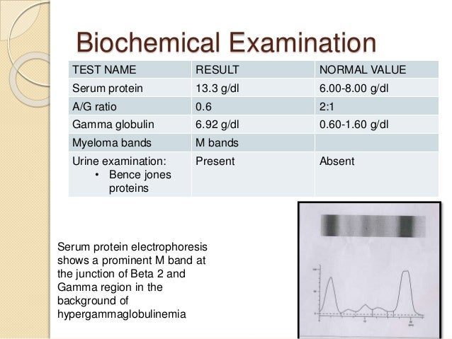 Myeloma Urine Test , Multiple Myeloma Diagnosis & Tests – LQVE