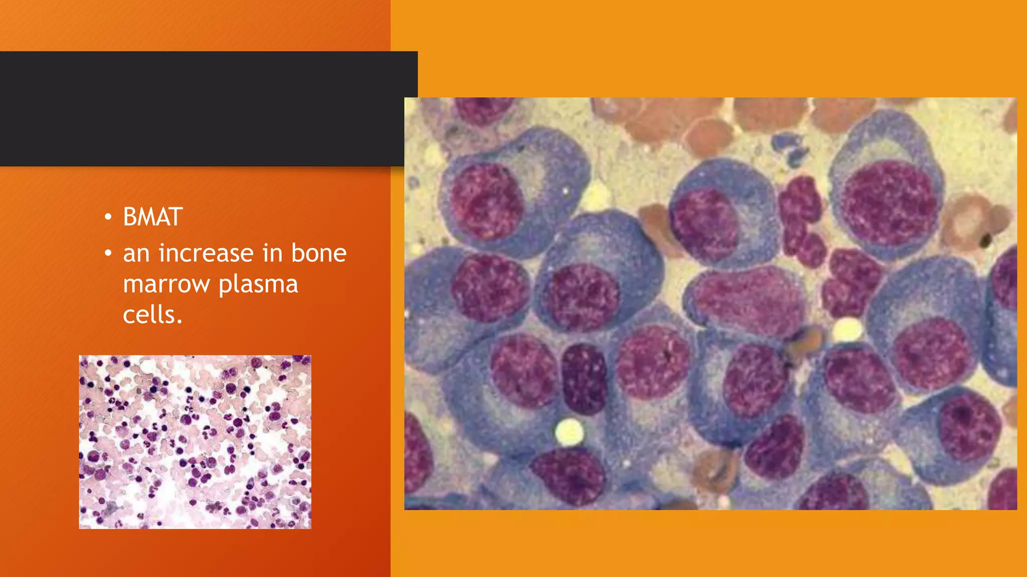 • BMAT
• an increase in bone
marrow plasma
cells.
 