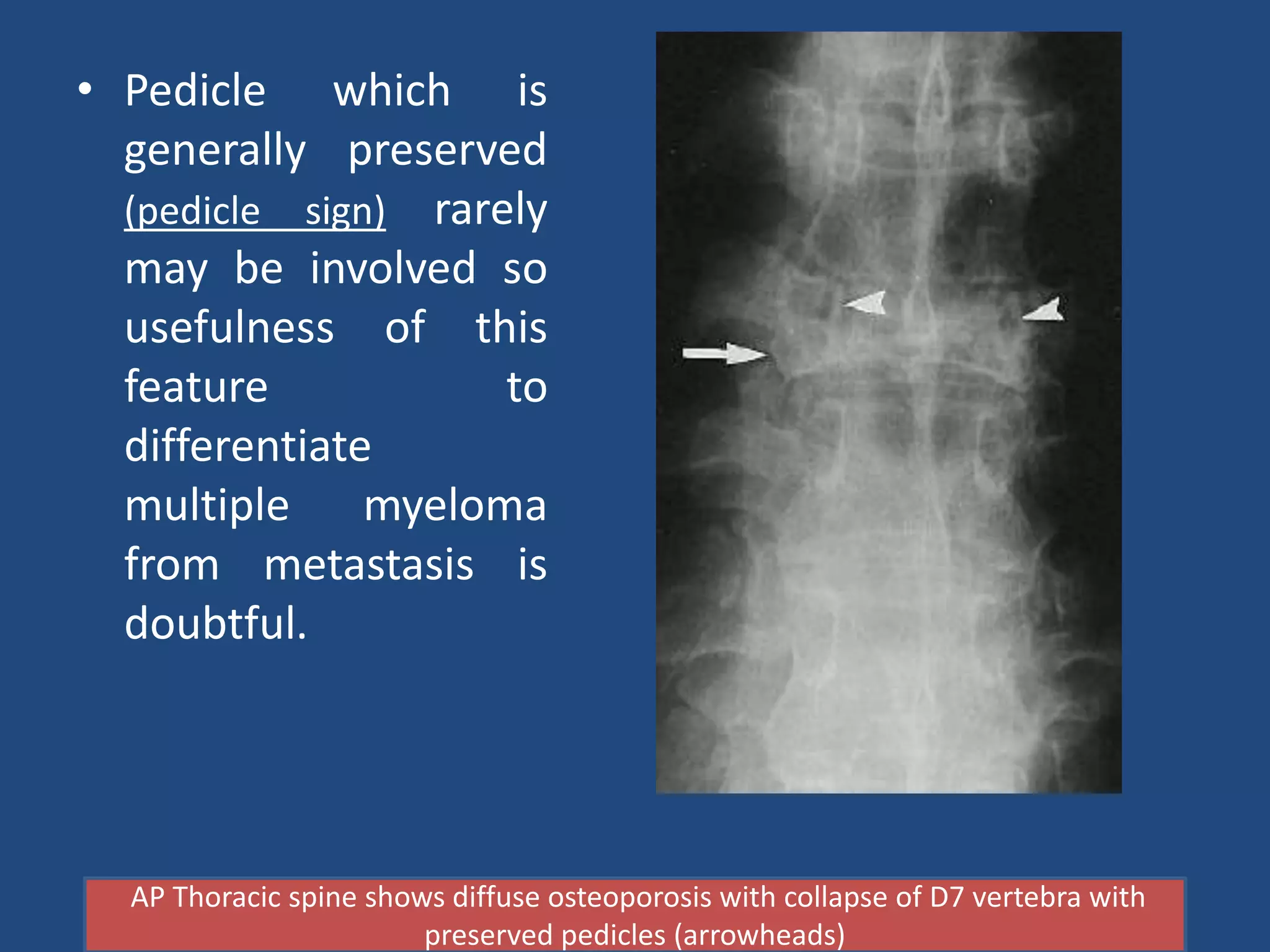 Case Presentation on Multiple Myeloma by Dr. Brajesh K. Ben | PPTX
