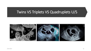 Twins VS Triplets VS Quadruplets U/S
2/01/2023 16
 