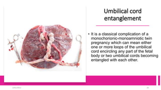 Umbilical cord
entanglement
• It is a classical complication of a
monochorionic-monoamniotic twin
pregnancy which can mean either
one or more loops of the umbilical
cord encircling any part of the fetal
body or two umbilical cords becoming
entangled with each other.
2/01/2023 26
 