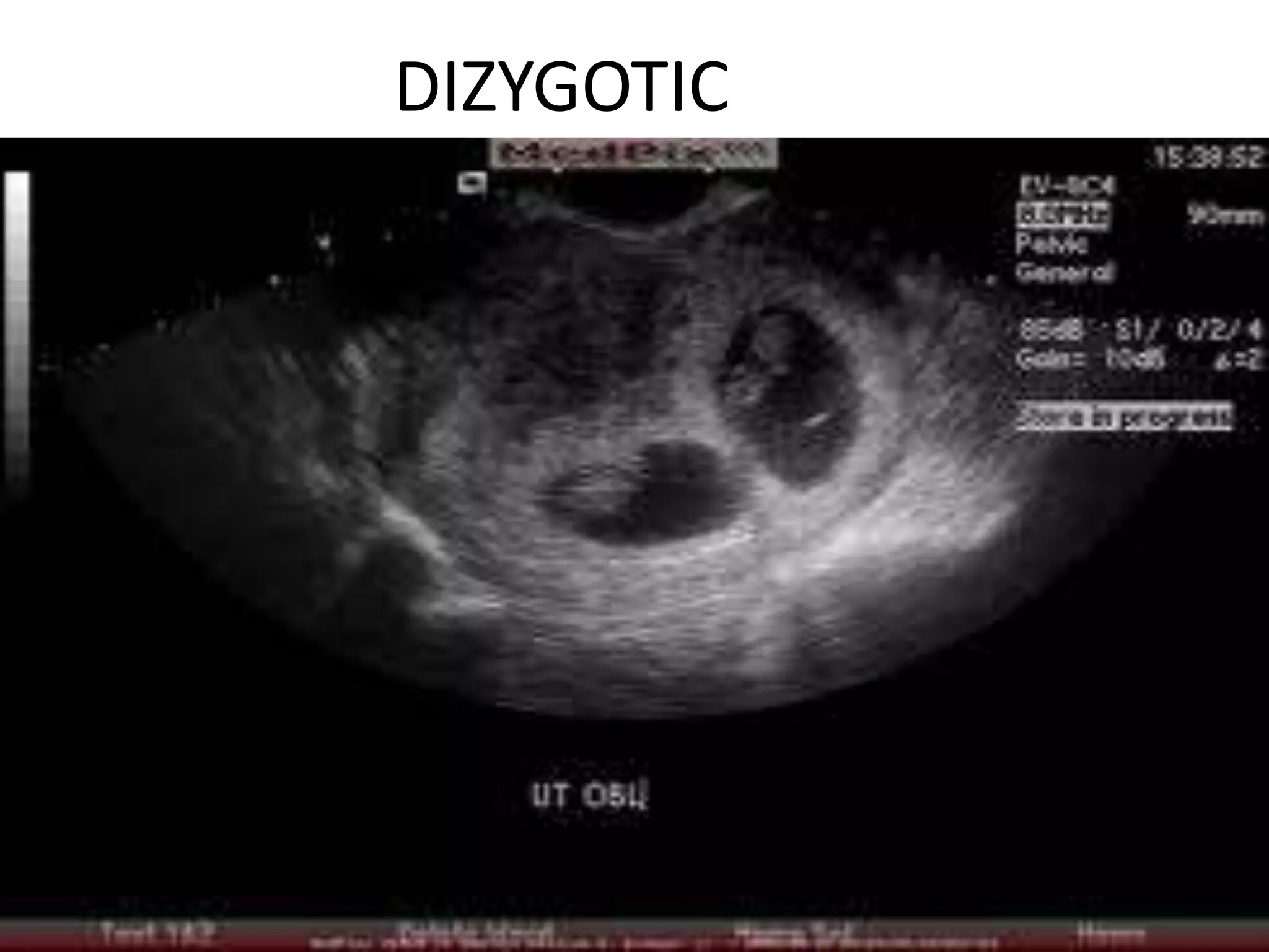 DIZYGOTIC
 