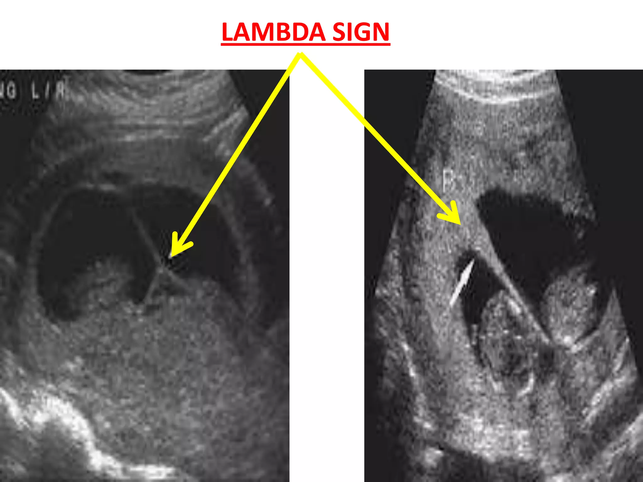 LAMBDA SIGN
 