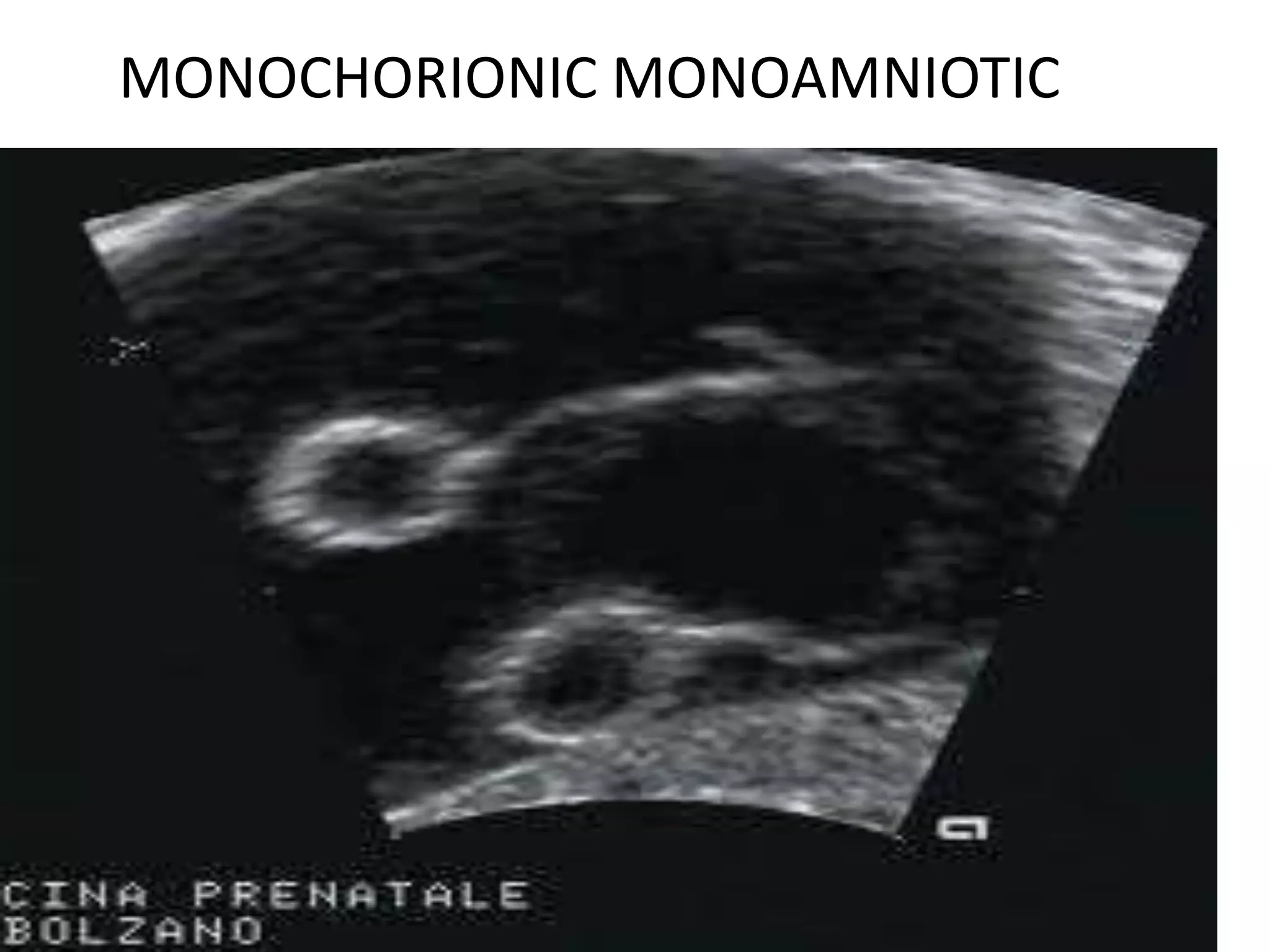 MONOCHORIONIC MONOAMNIOTIC
 