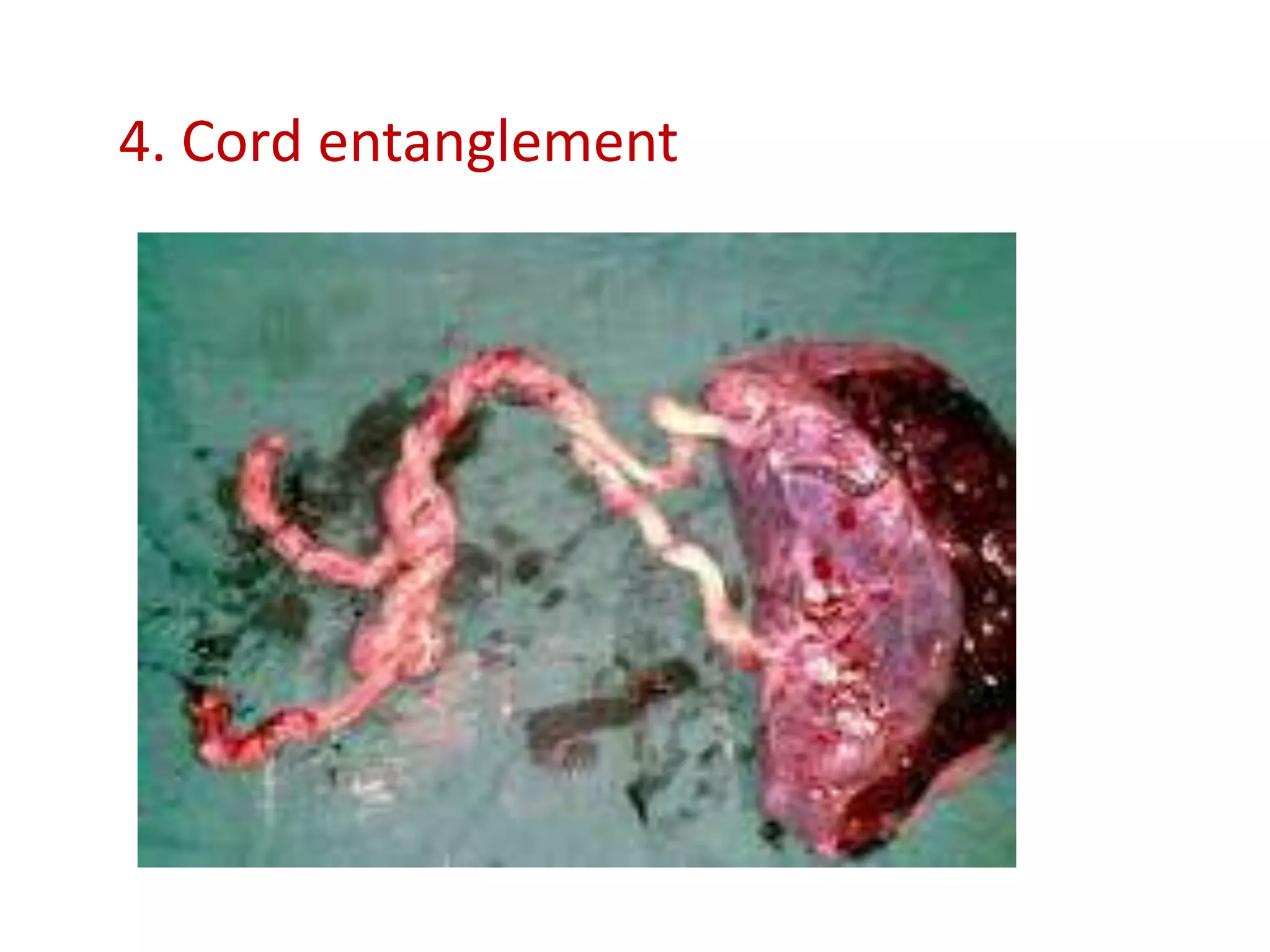 4. Cord entanglement
 