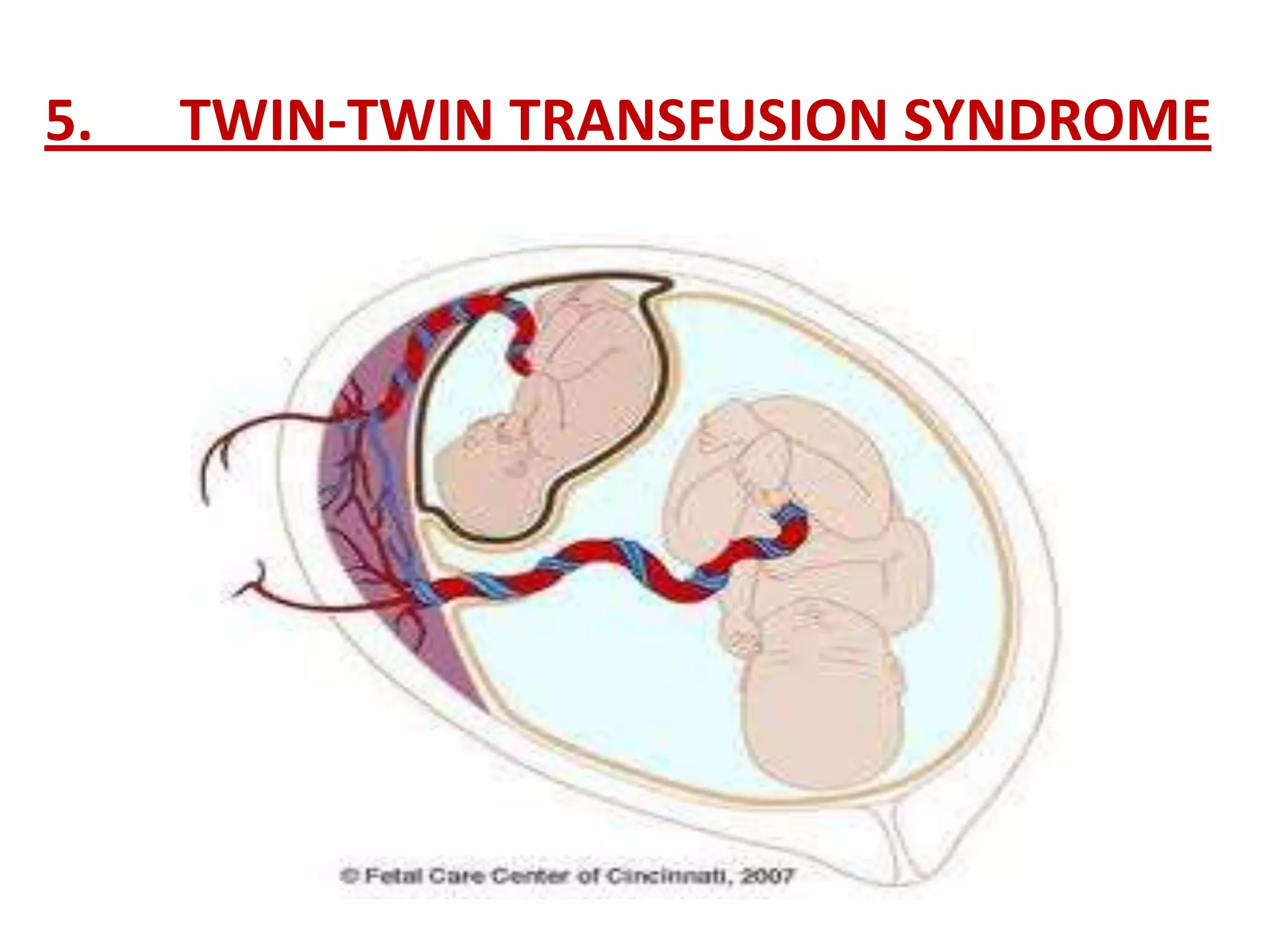 5.   TWIN-TWIN TRANSFUSION SYNDROME
 