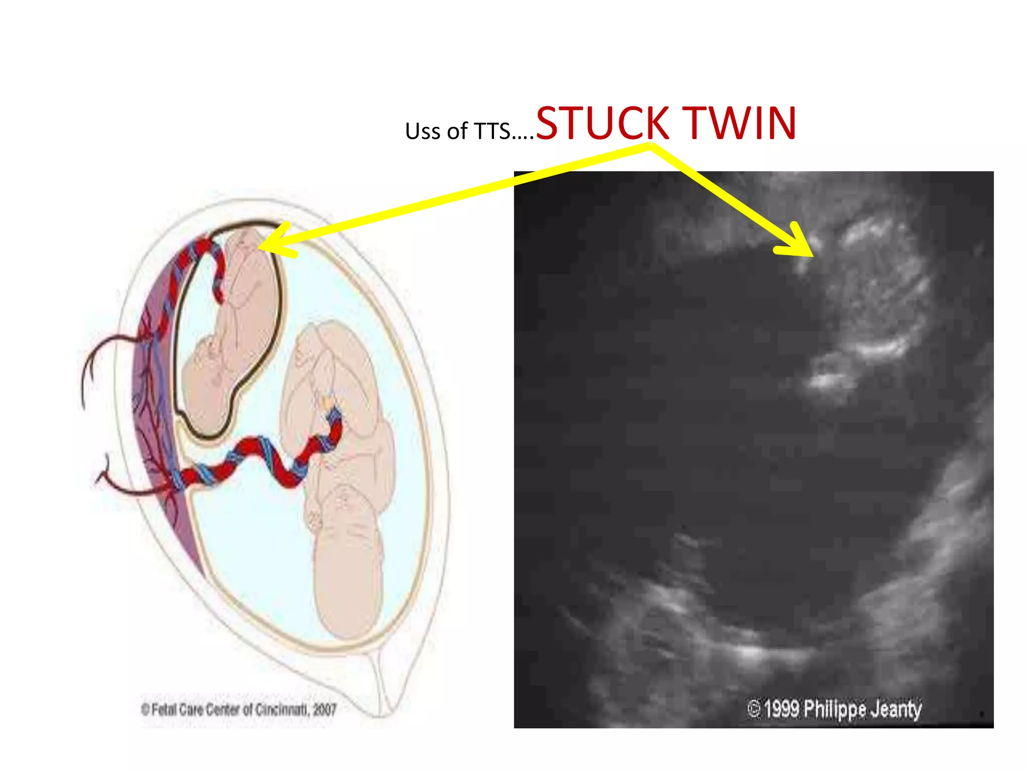 Uss of TTS….   STUCK TWIN
 