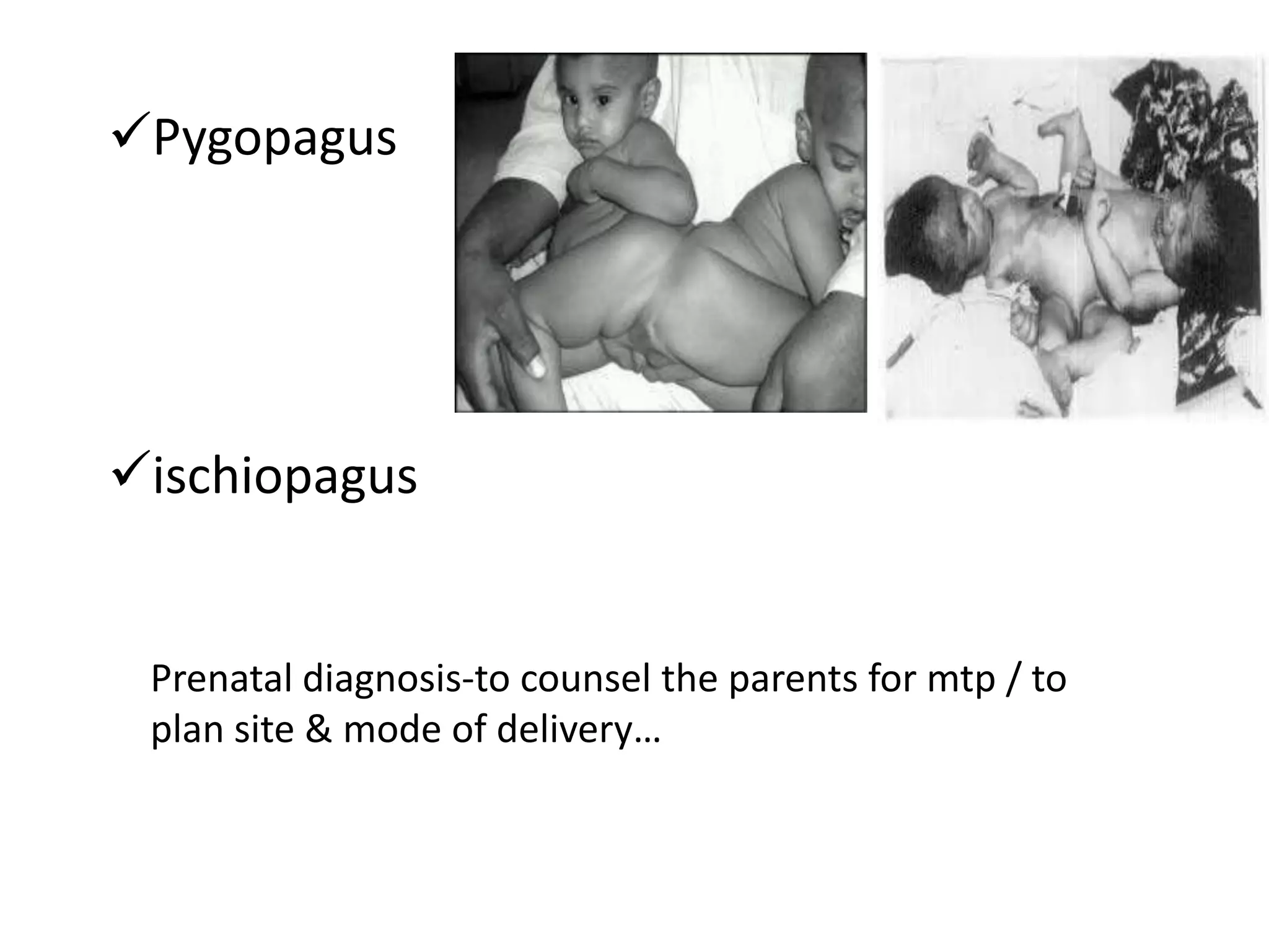 Pygopagus




ischiopagus


 Prenatal diagnosis-to counsel the parents for mtp / to
 plan site & mode of delivery…
 