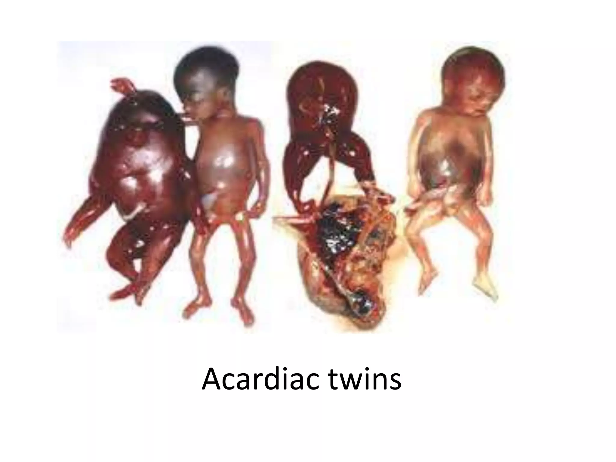 Acardiac twins
 