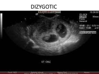 DIZYGOTIC
 
