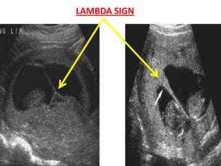 LAMBDA SIGN
 