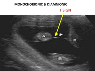 MONOCHORIONIC & DIAMNIONIC
                      T SIGN
 