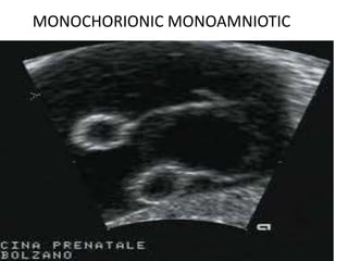 MONOCHORIONIC MONOAMNIOTIC
 