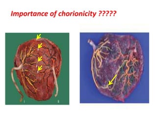 Importance of chorionicity ?????
 