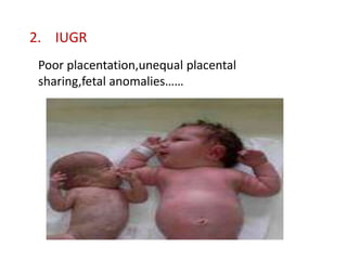 2. IUGR
 Poor placentation,unequal placental
 sharing,fetal anomalies……
 