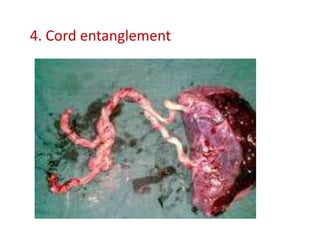 4. Cord entanglement
 